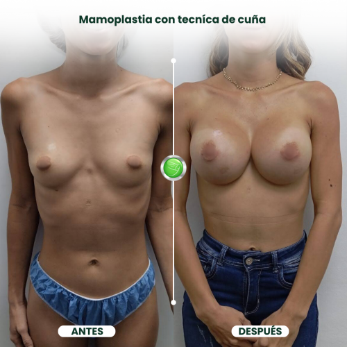 MAMOPLASTIA DE AUMENTO TÉCNICA DE CUÑA