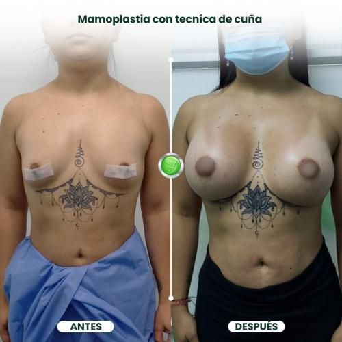 MAMOPLASTIA DE AUMENTO TÉCNICA DE CUÑA