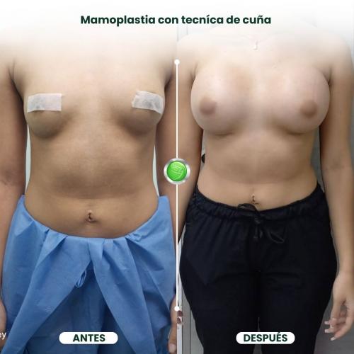MAMOPLASTIA DE AUMENTO TÉCNICA DE CUÑA