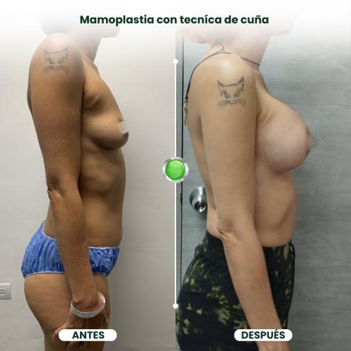 MAMOPLASTIA DE AUMENTO TÉCNICA DE CUÑA
