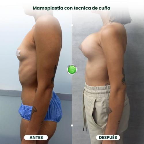 MAMOPLASTIA DE AUMENTO TÉCNICA DE CUÑA