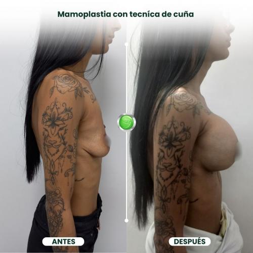 MAMOPLASTIA DE AUMENTO TÉCNICA DE CUÑA