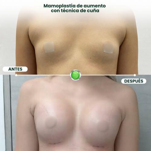 MAMOPLASTIA DE AUMENTO TÉCNICA DE CUÑA