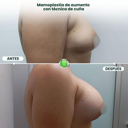 MAMOPLASTIA DE AUMENTO TÉCNICA DE CUÑA