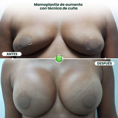 MAMOPLASTIA DE AUMENTO TÉCNICA DE CUÑA