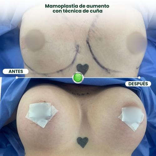 MAMOPLASTIA DE AUMENTO TÉCNICA DE CUÑA