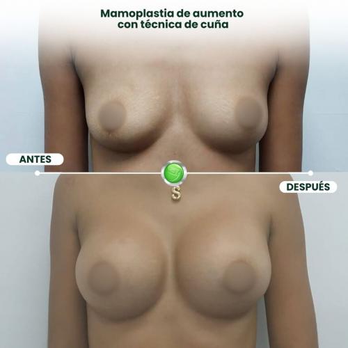 MAMOPLASTIA DE AUMENTO TÉCNICA DE CUÑA