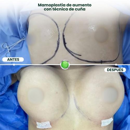 MAMOPLASTIA DE AUMENTO TÉCNICA DE CUÑA