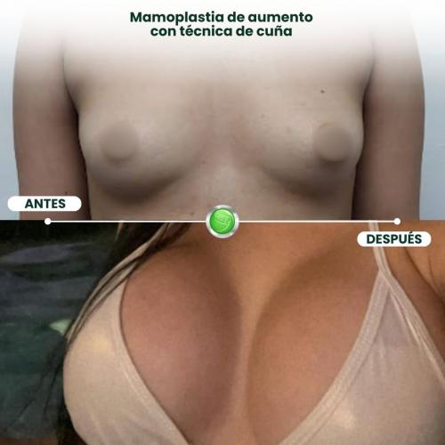 MAMOPLASTIA DE AUMENTO TÉCNICA DE CUÑA
