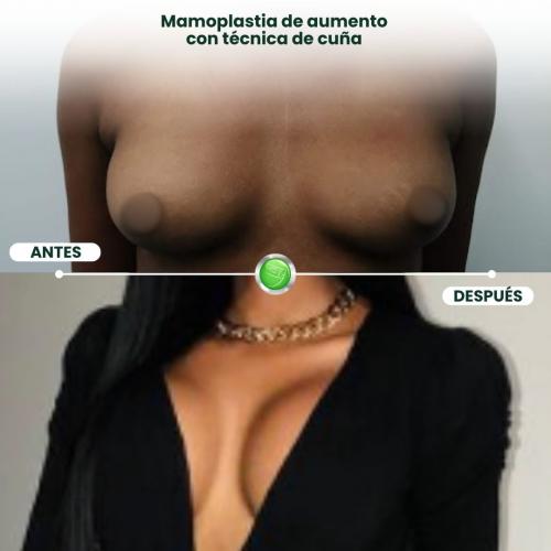 MAMOPLASTIA DE AUMENTO TÉCNICA DE CUÑA