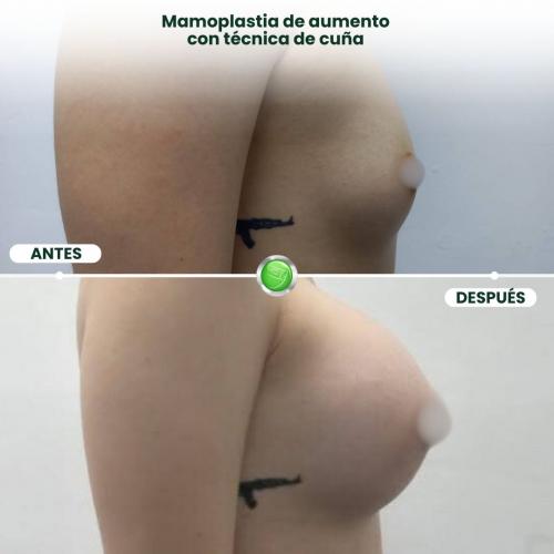 MAMOPLASTIA DE AUMENTO TÉCNICA DE CUÑA