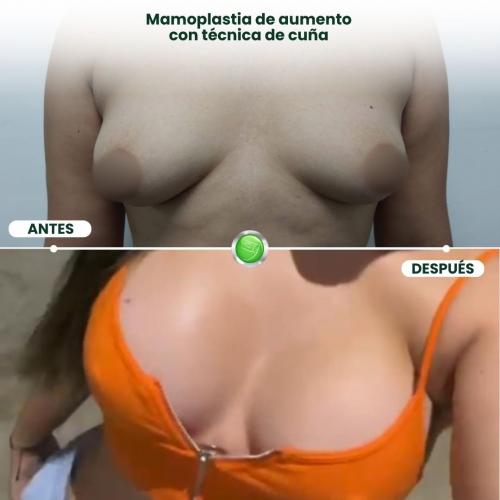 MAMOPLASTIA DE AUMENTO TÉCNICA DE CUÑA
