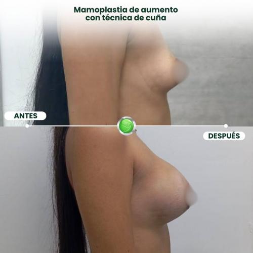 MAMOPLASTIA DE AUMENTO TÉCNICA DE CUÑA