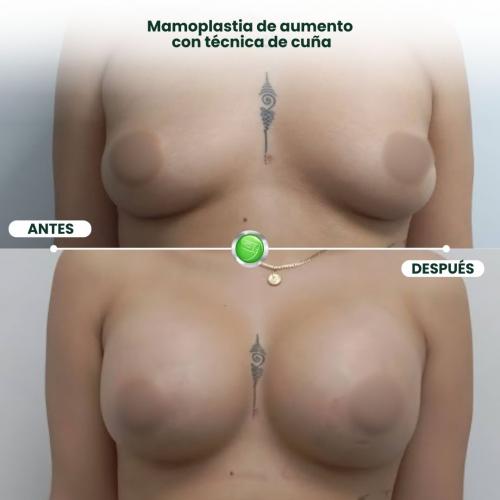 MAMOPLASTIA DE AUMENTO TÉCNICA DE CUÑA