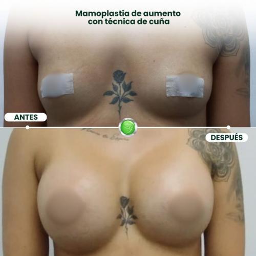 MAMOPLASTIA DE AUMENTO TÉCNICA DE CUÑA