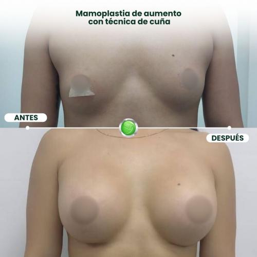 MAMOPLASTIA DE AUMENTO TÉCNICA DE CUÑA