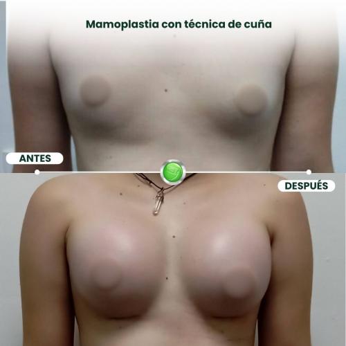 MAMOPLASTIA DE AUMENTO TÉCNICA DE CUÑA