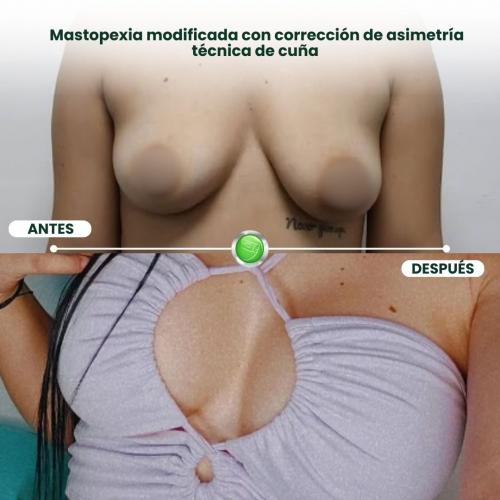 Mastopexia modificada con técnica de cuña