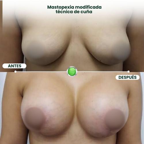 Mastopexia modificada con técnica de cuña